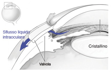 Operazione Glaucoma