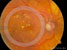 Retinopatia diabetica essudativa