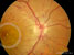 Retinopatia diabetica proliferativa 1