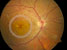 Retinopatia diabetica proliferativa 2